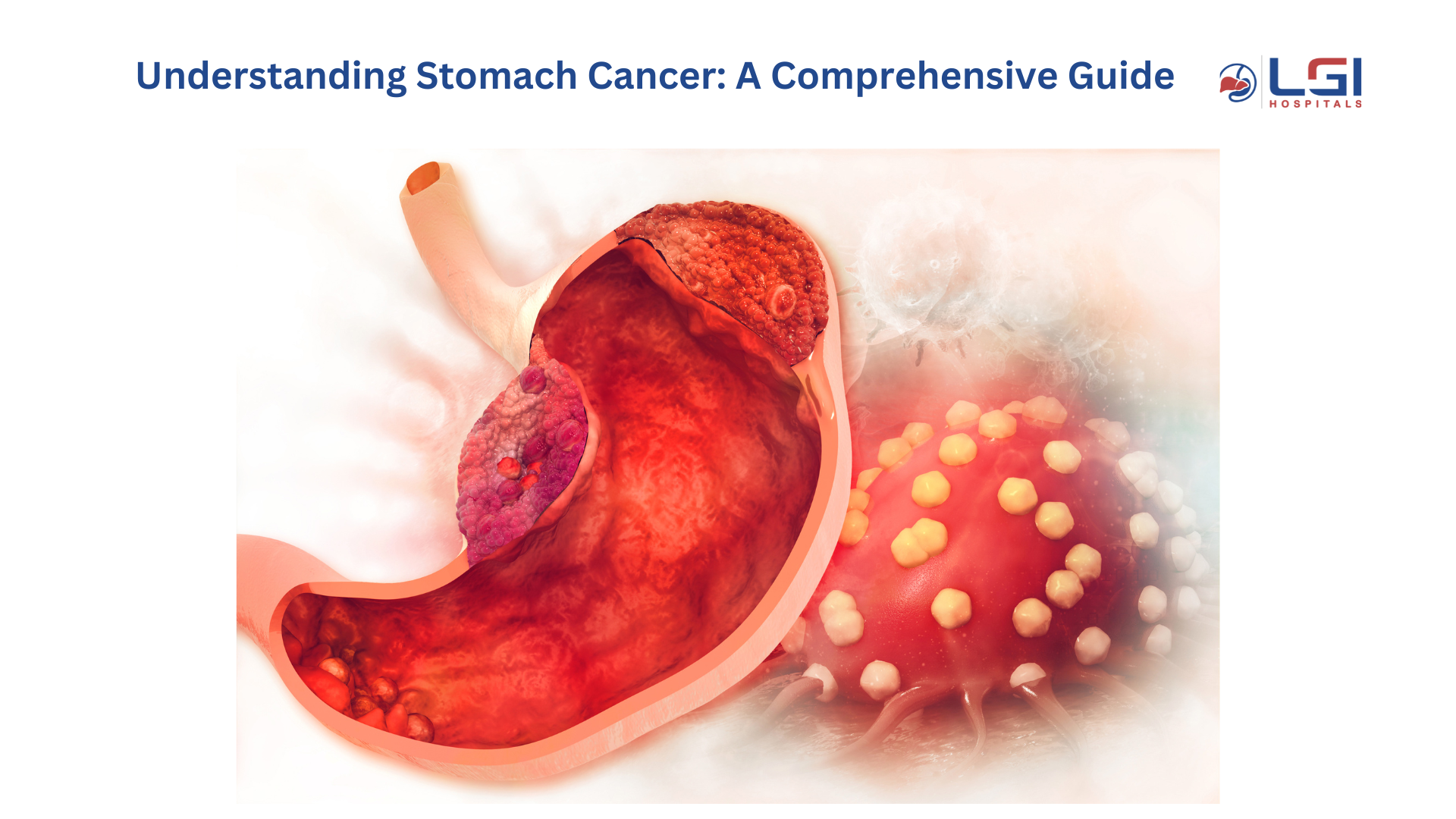 stomach cancer signs & symptoms