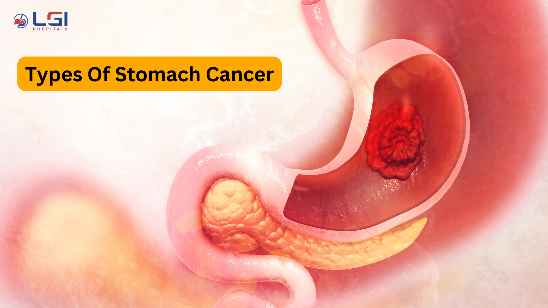 types of stomach cancer