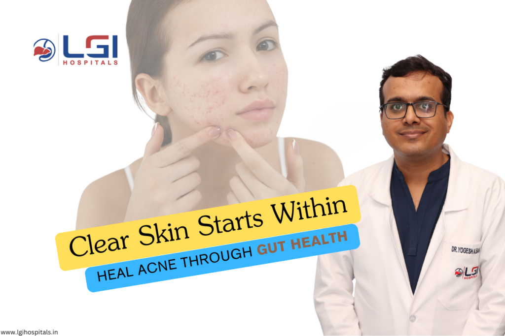 Link between Gut Health & Acne for Clear Skin | LGI Hospital