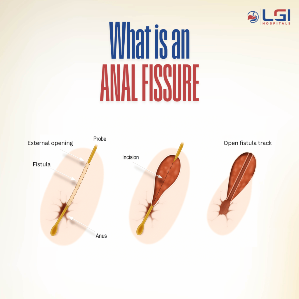 Illustration of anal fissure showing a cut at the anal opening