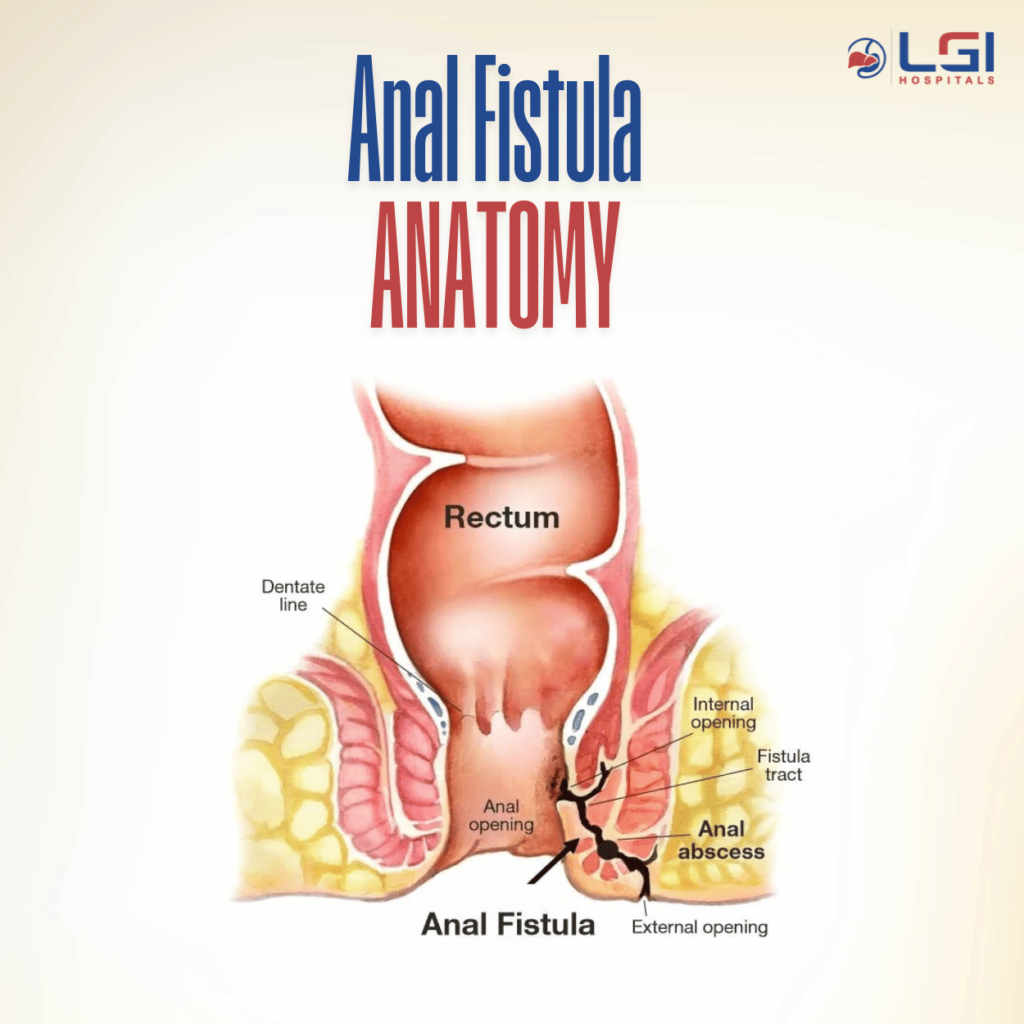 Diagram showing fistula tunnel from anal canal to skin surface