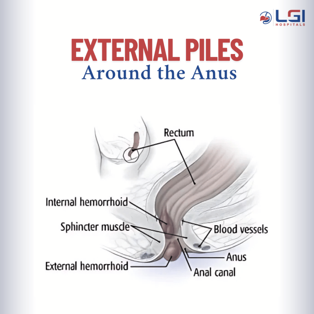 External piles showing visible swollen lumps near anus