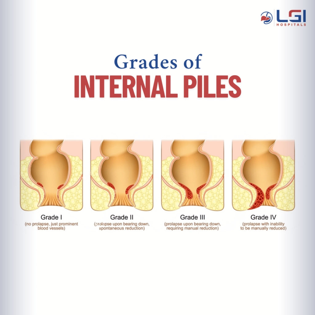 Internal piles with grade I to IV prolapse illustration