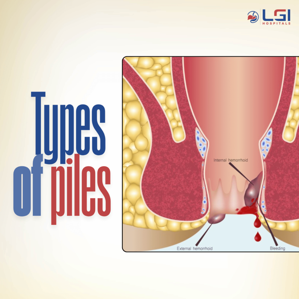 Diagram showing internal and external hemorrhoids and their symptoms