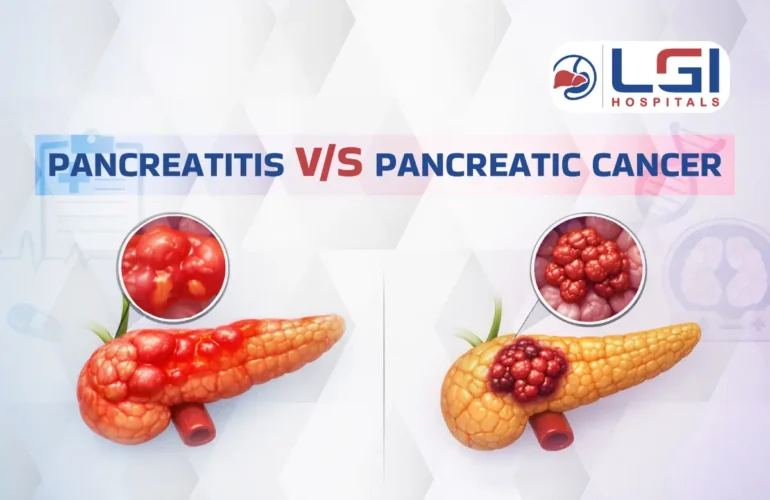 pancreas diseases and pancreatic cancer