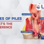 types of piles