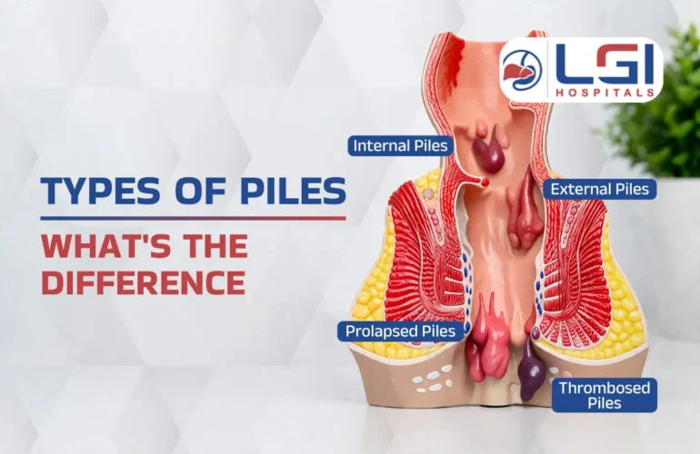 types of piles