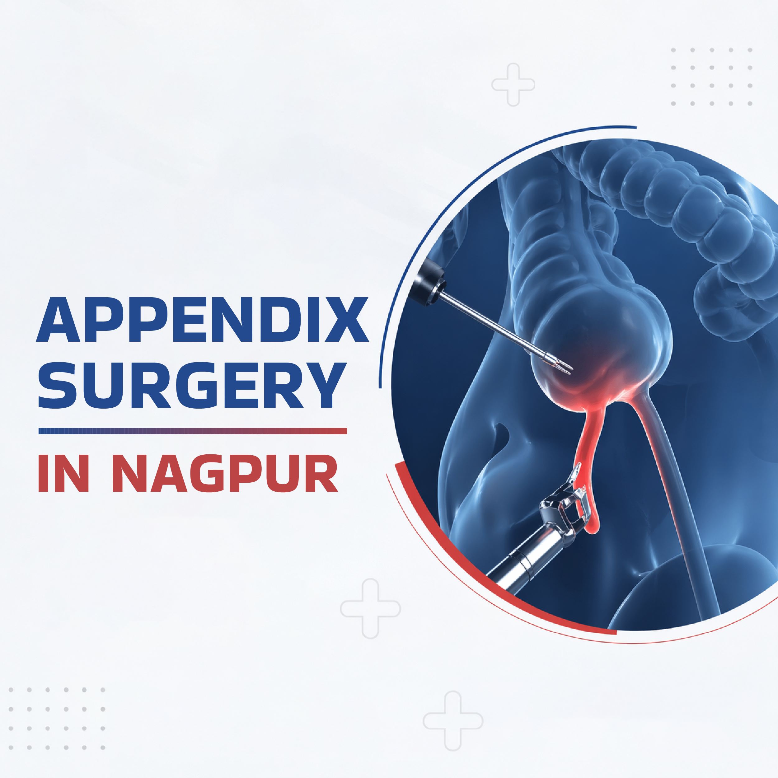 Appendix Surgery in Nagpur | LGI Hospital