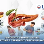 pancreatic-stones causes, symptoms, treatment