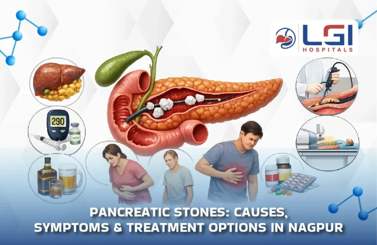 pancreatic-stones causes, symptoms, treatment