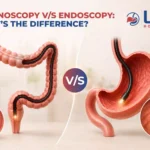Colonoscopy Vs Endoscopy