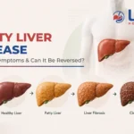 fatty liver disease
